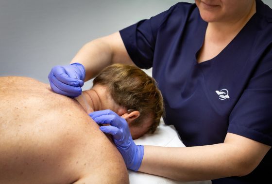 Sesión de punción seca aplicada por fisioterapeuta en Clínica Batean Bilbao
