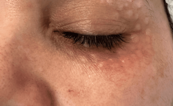 Mesoterapia facial Bilbao